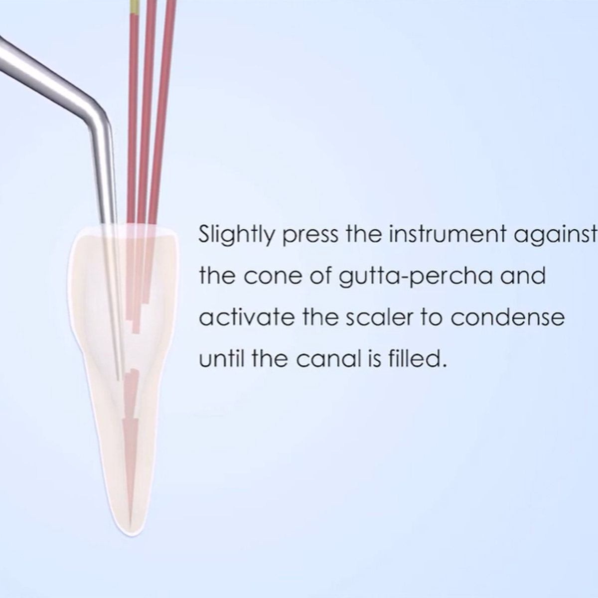 Woodpecker Scaler Tip E3 for UDS & EMS Scalers
