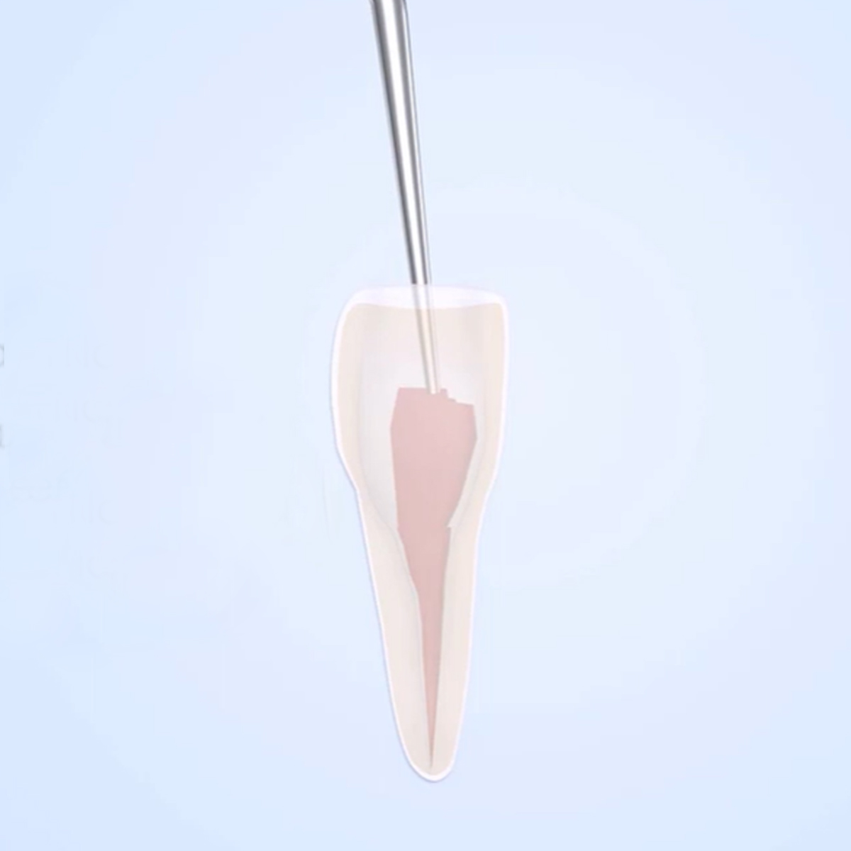 Woodpecker Scaler Tip E3 for UDS & EMS Scalers