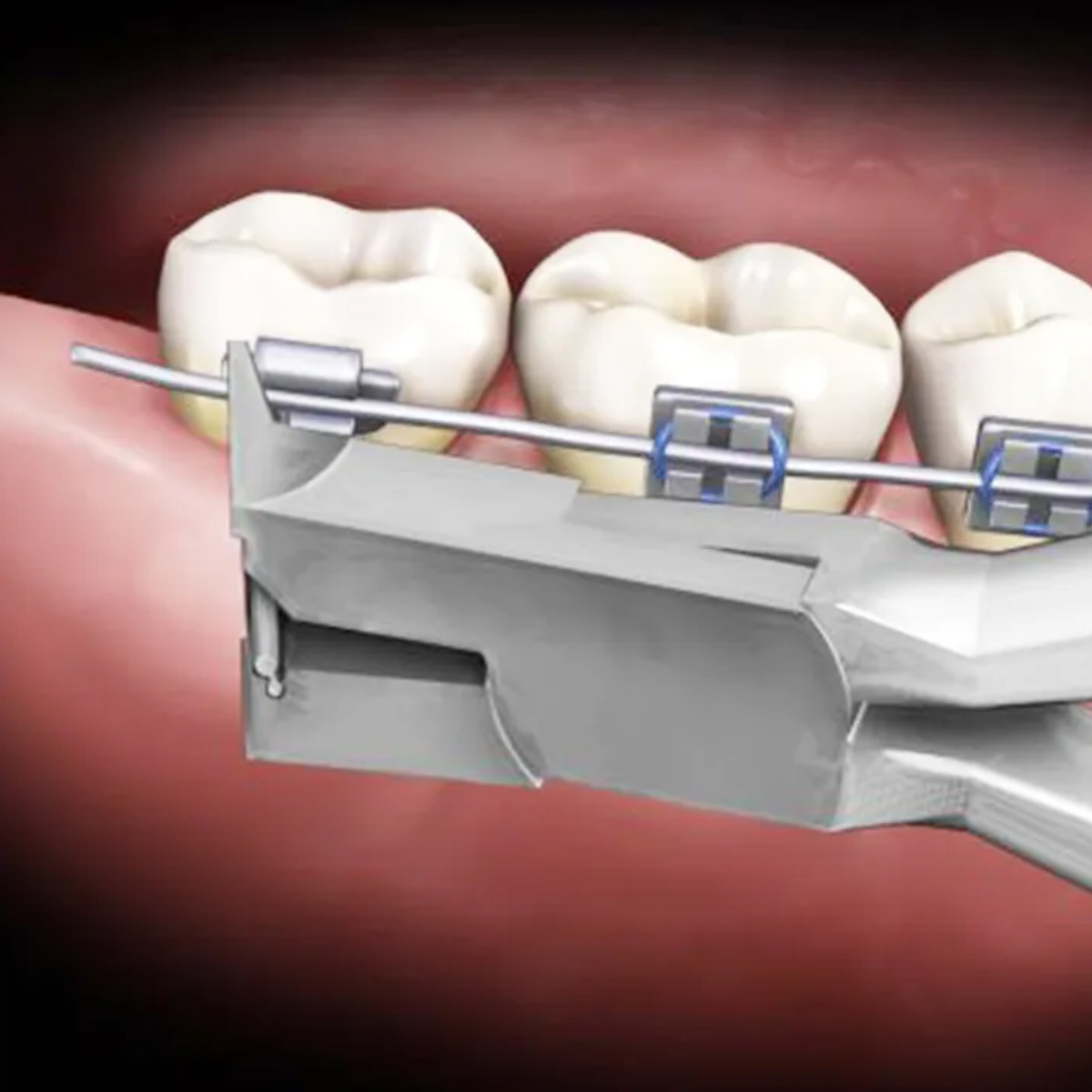 GDC Orthodontics Cutter Tc Distal End Cutter - Micro (3000/101)