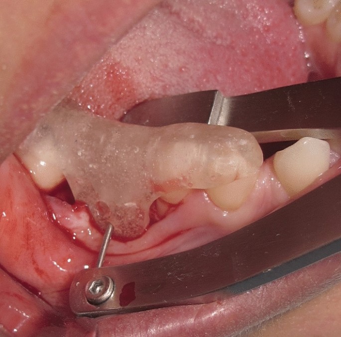 Oracraft Bone Mill And Calipers