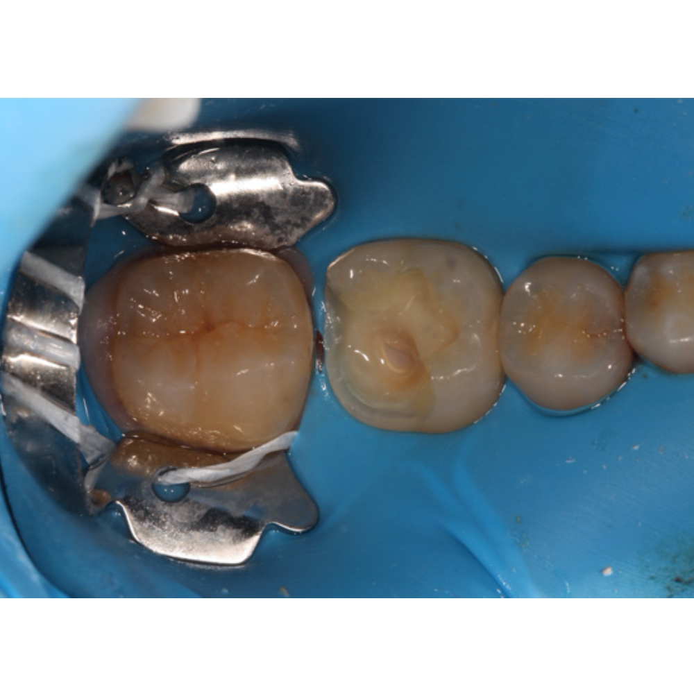 GDC Rubber Dam Clamp Adult 12a (Rdc12a)