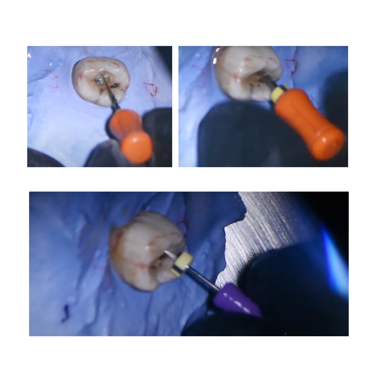 Waldent Pro-Taper Gold Hand files