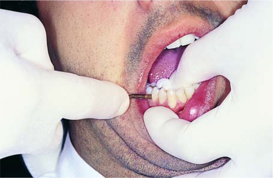 Waldent Root Elevators Premium Set of 11 (K2/2)