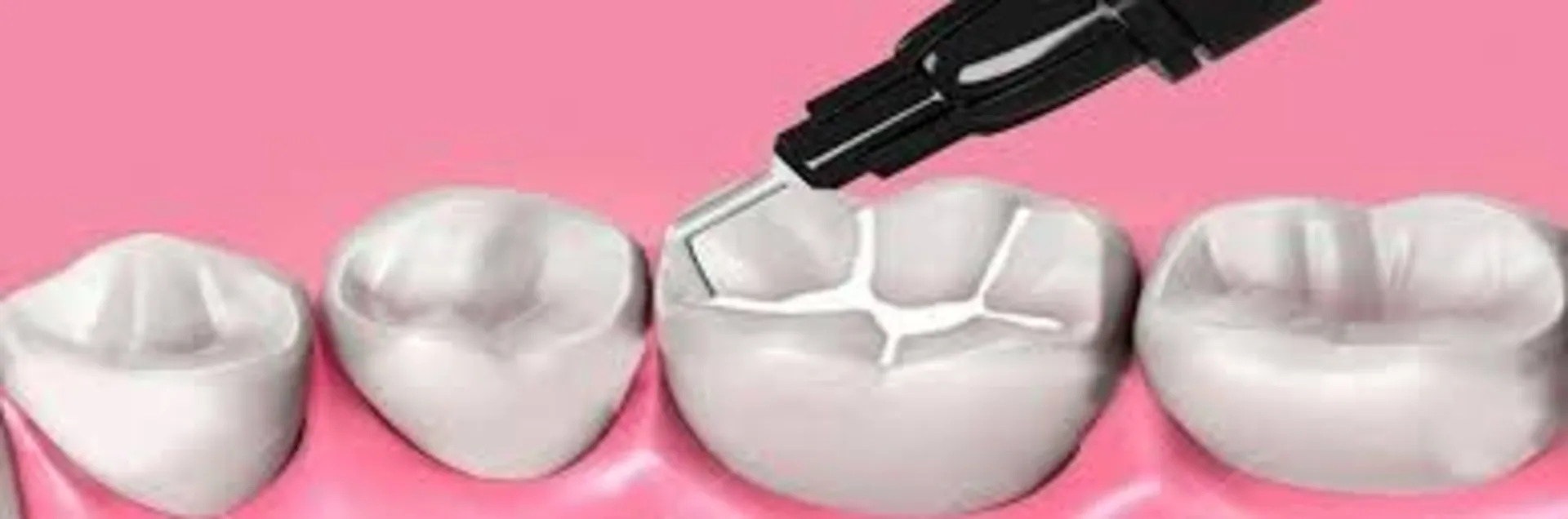 Sdi Wave Flowable Composite A3