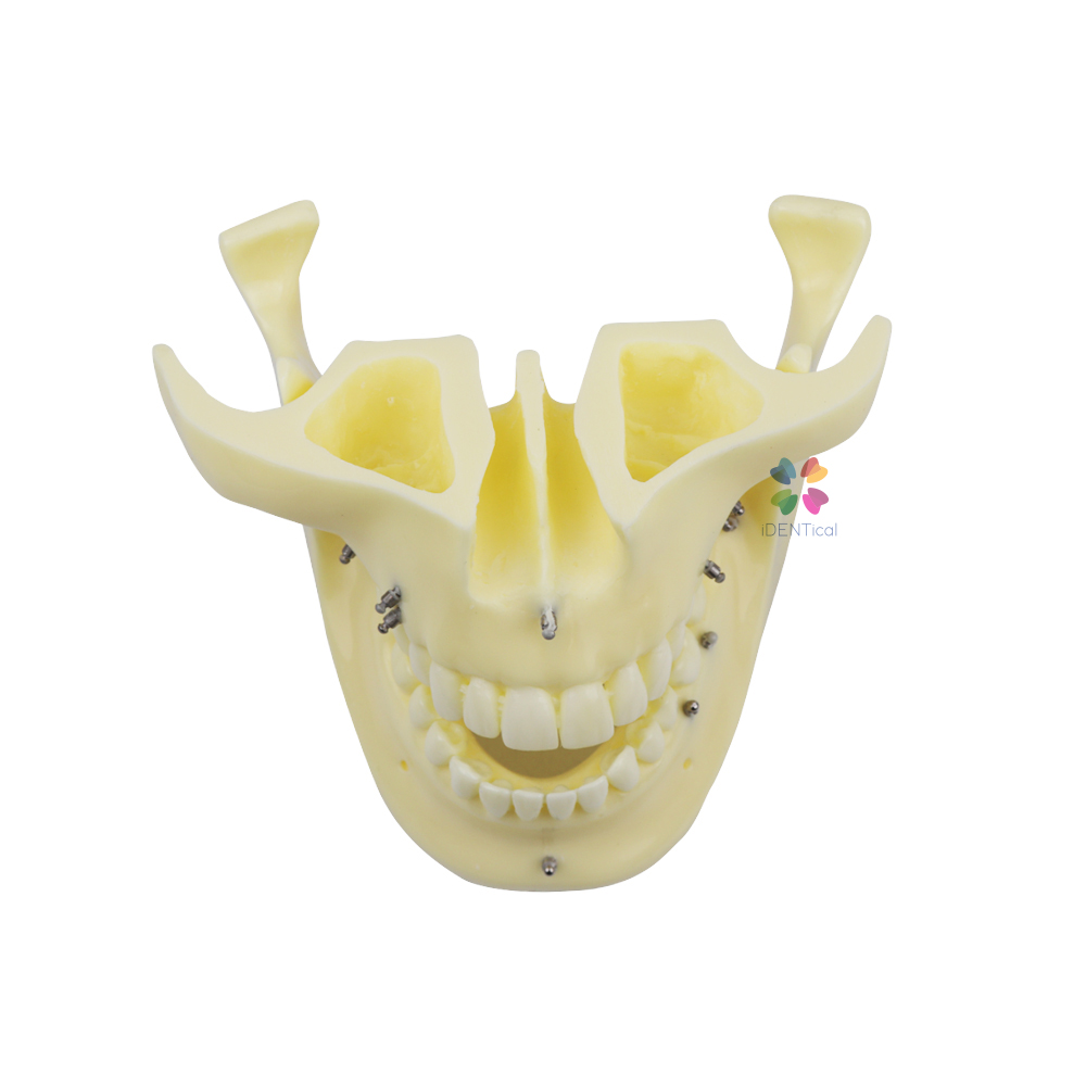 iDentical Orthodontic Implant Model - M2016