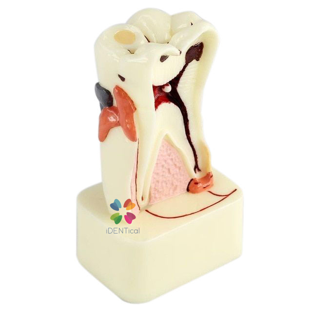 iDentical 4X Pathologies Of Tooth Model - M4015