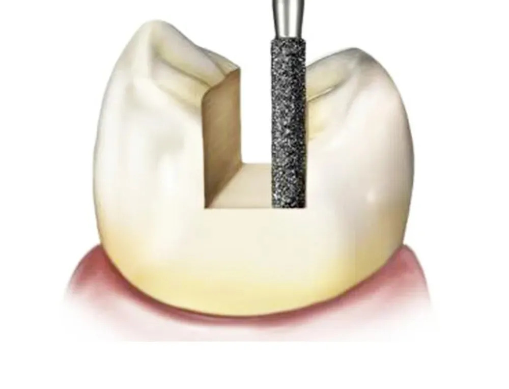 Frank Dental Cylinder Flat End FG Diamond Bur - Pack of 5