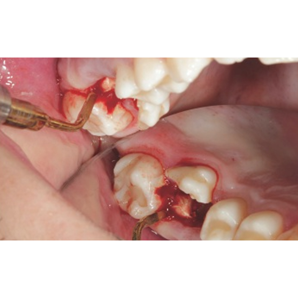 Woodpecker HB-1L Piezo Bone Surgery Handpiece