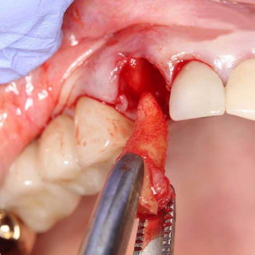 Waldent Tooth Extraction Forceps