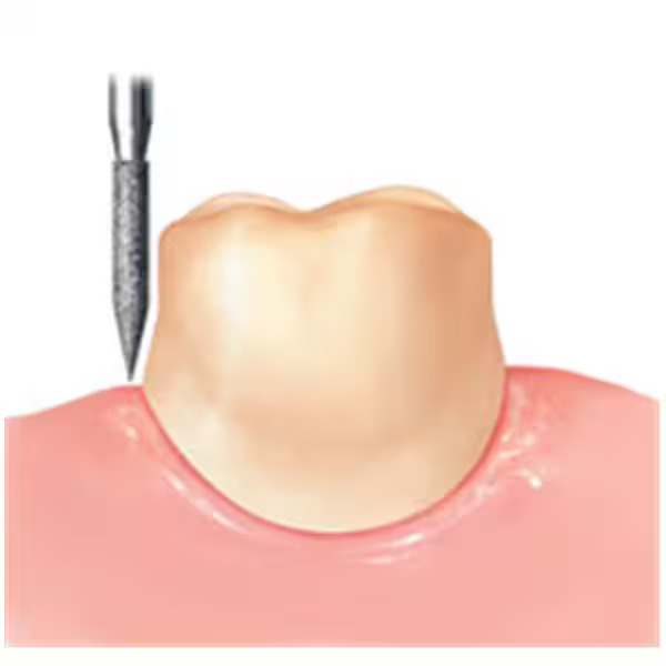 Frank Dental Tapered Ogival FG Diamond Burs TO- Series (Coarse)