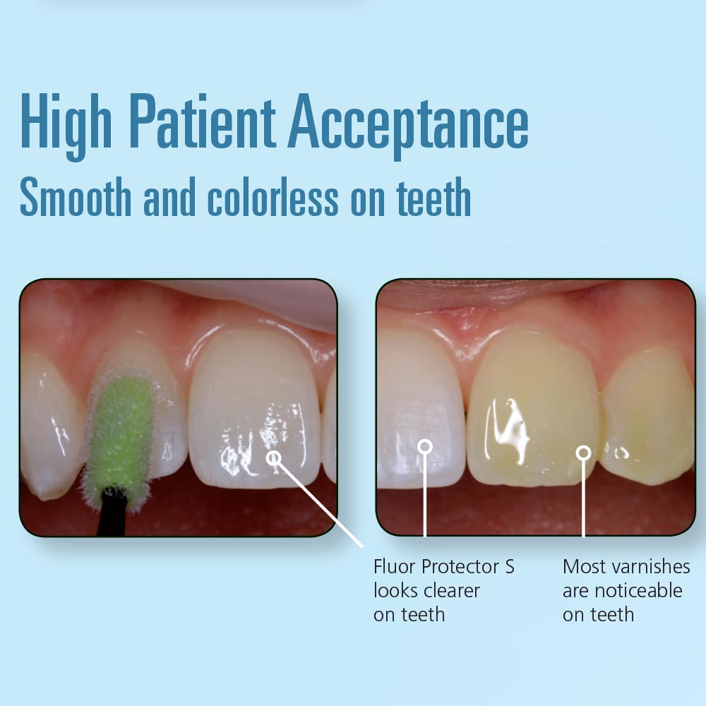 Ivoclar FluorProtector S Fluoride Protective Varnish Unit Dose 0.26g 