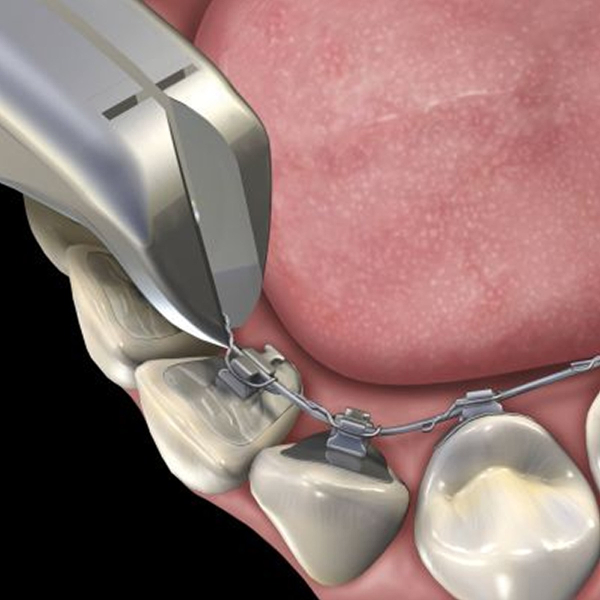 GDC Pin Ligature Cutter 45° 3000/111