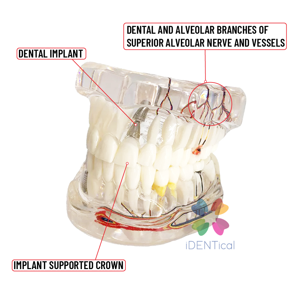 iDENTical Patient Education Model (Caries,implant,Nerves) M2001-3