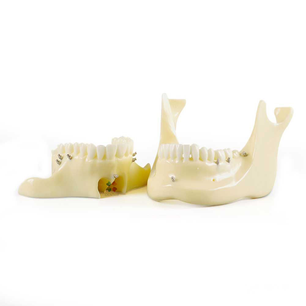 iDentical Orthodontic Implant Model - M2016