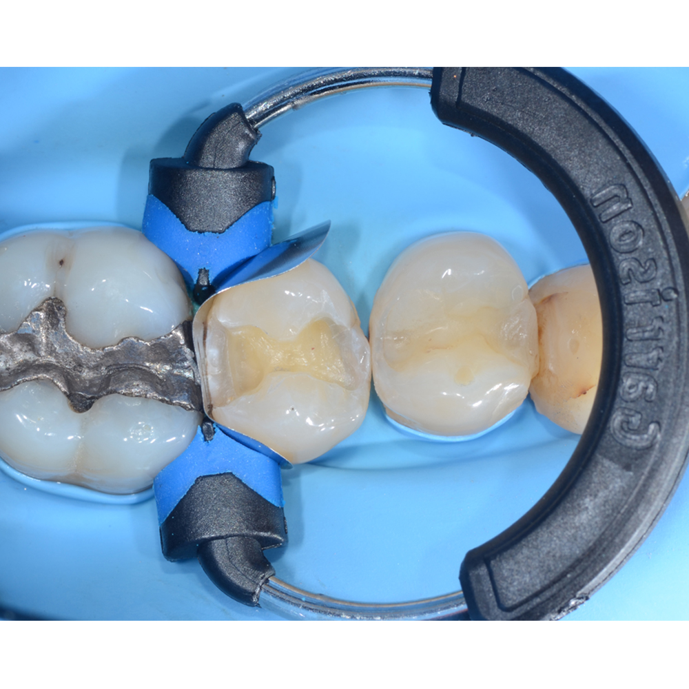 Garrison Dental Composi-Tight 3DXR Ring (3DXR-1)