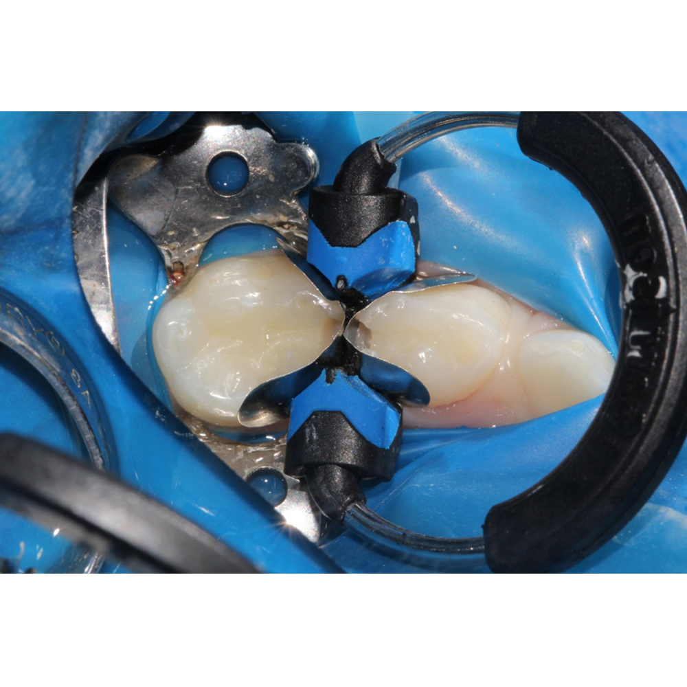 Garrison Dental Composi-Tight 3DXR Ring (3DXR-1)