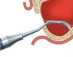 Waldent Sinus Lift Kit 8Pcs Set (K19/6)