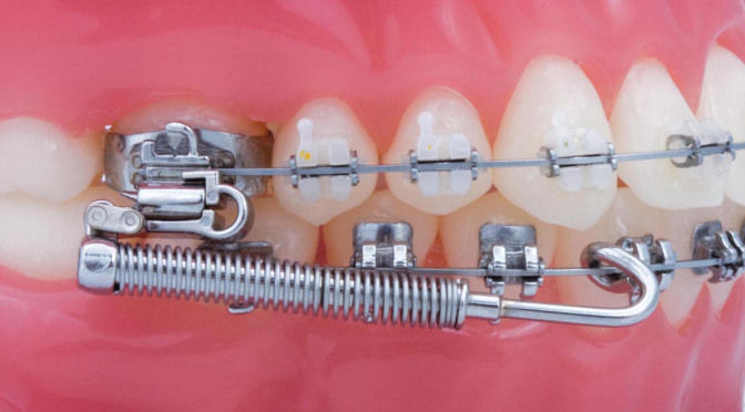 3m Unitek Forsus Fatigue Resistant Device L-Pin Module