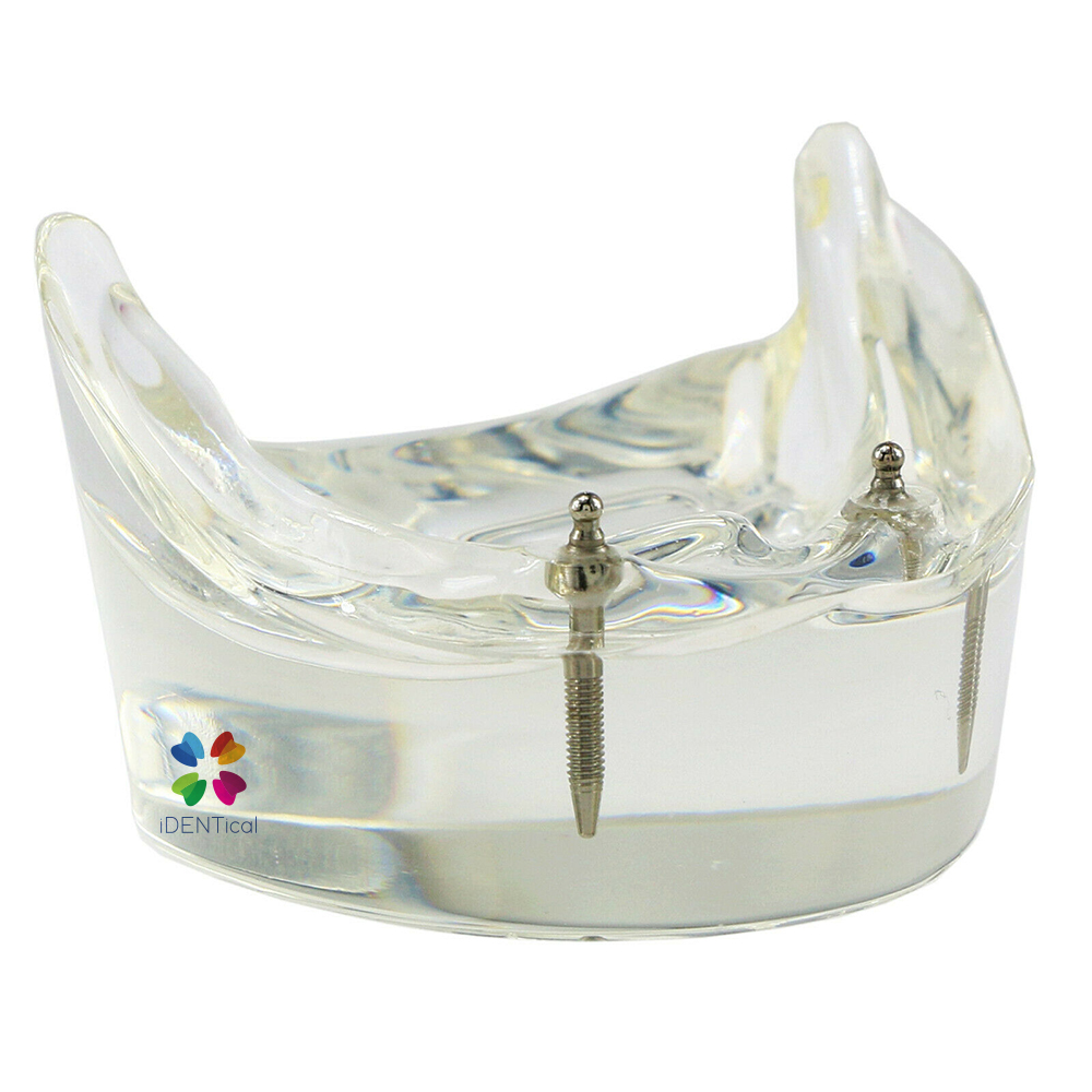 iDENTical Mandibular Overdenture Model with 2 Implants M6002