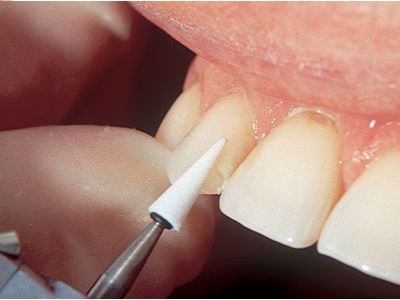 ET Dental Composite Finishing & Polishing Kit FG