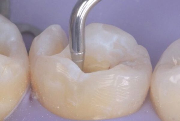 LM Arte Complete Set - 8 Restorative Instruments With Cassette