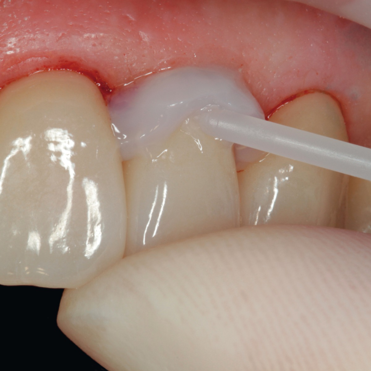 Ivoclar Vivadent Liquid Strip Glycerine Gel 