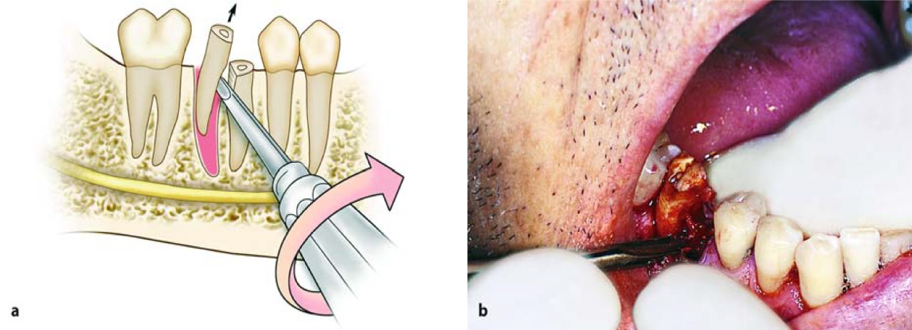 Waldent Root Elevators Premium Set of 11 (K2/2)