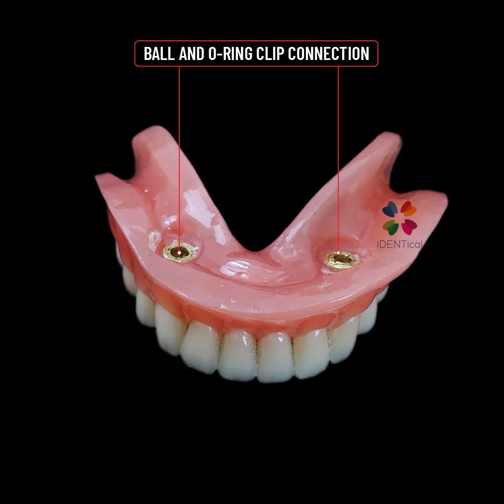 Dental Implant Locator Attachment O Ring Studs, Full Denture Hader Bar