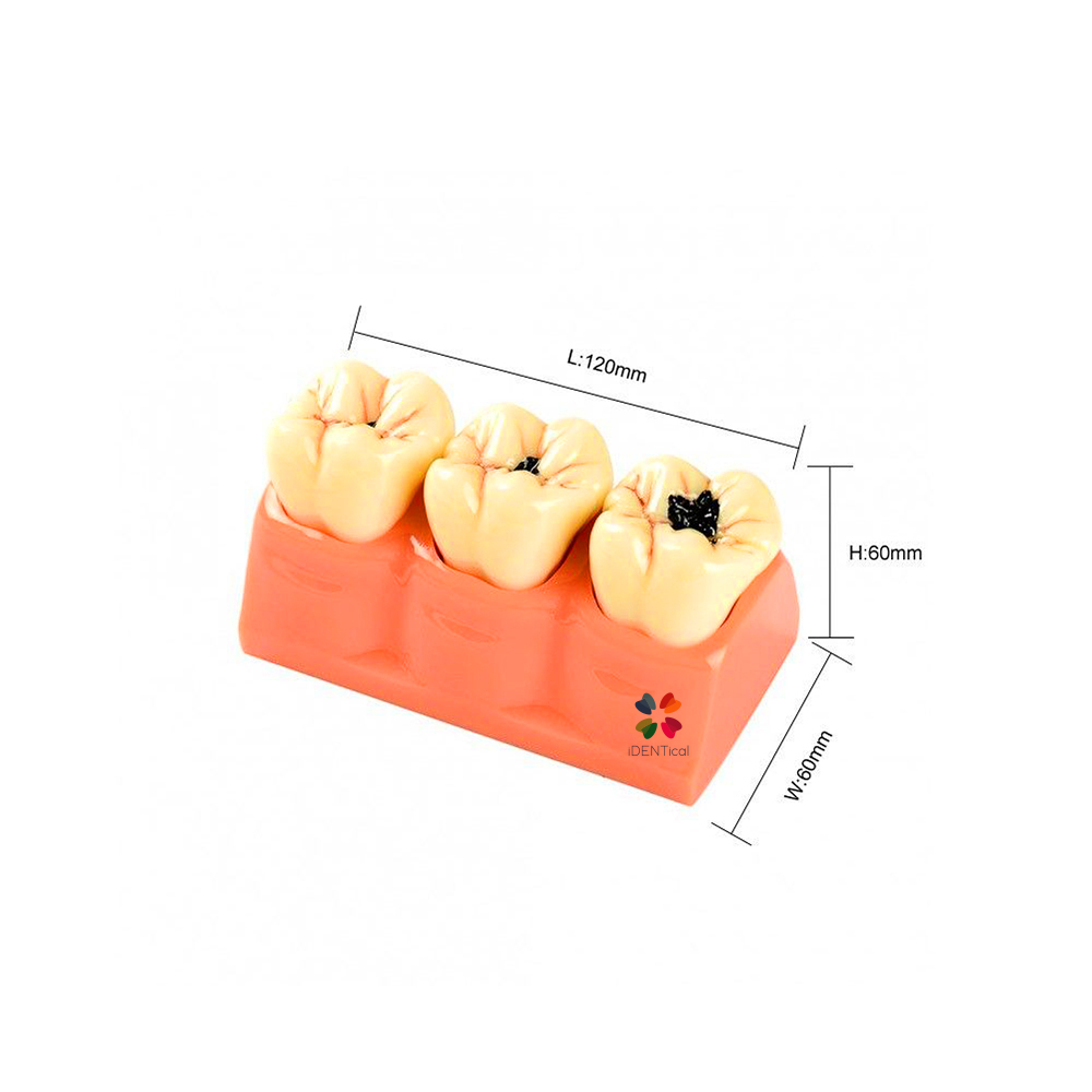 iDENTical Caries Development Tooth Model M4020