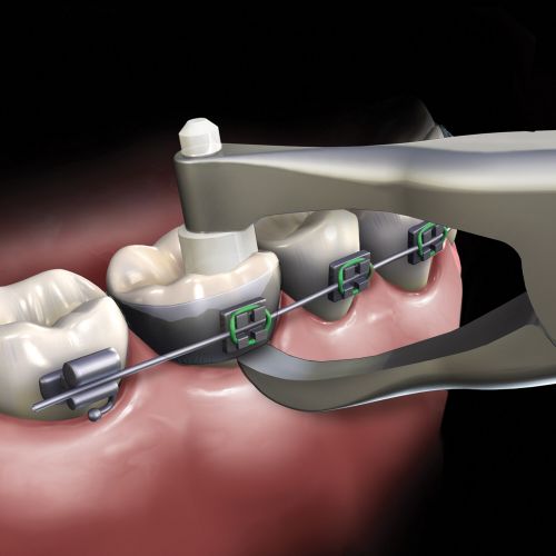 Waldent Posterior Band Remover Long TC 10/104