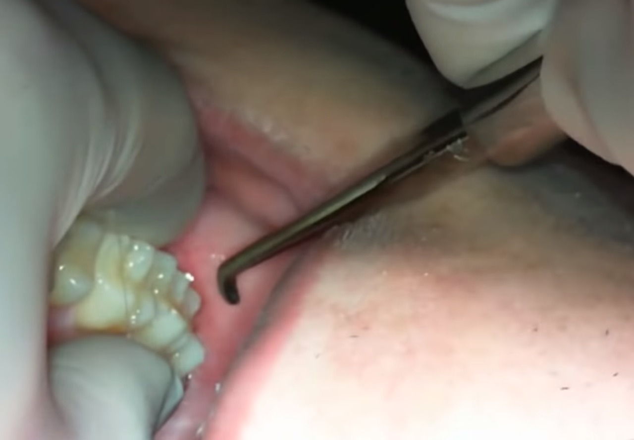 Waldent Root Elevators Warwick James Set of 3 (K2/3)