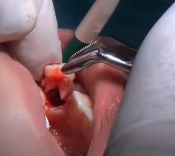 Waldent Pedo Extraction Forceps Kit Set of 7 (K1/2)