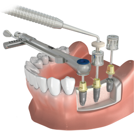 Waldent Dental Implant Prosthetic Universal Kit 