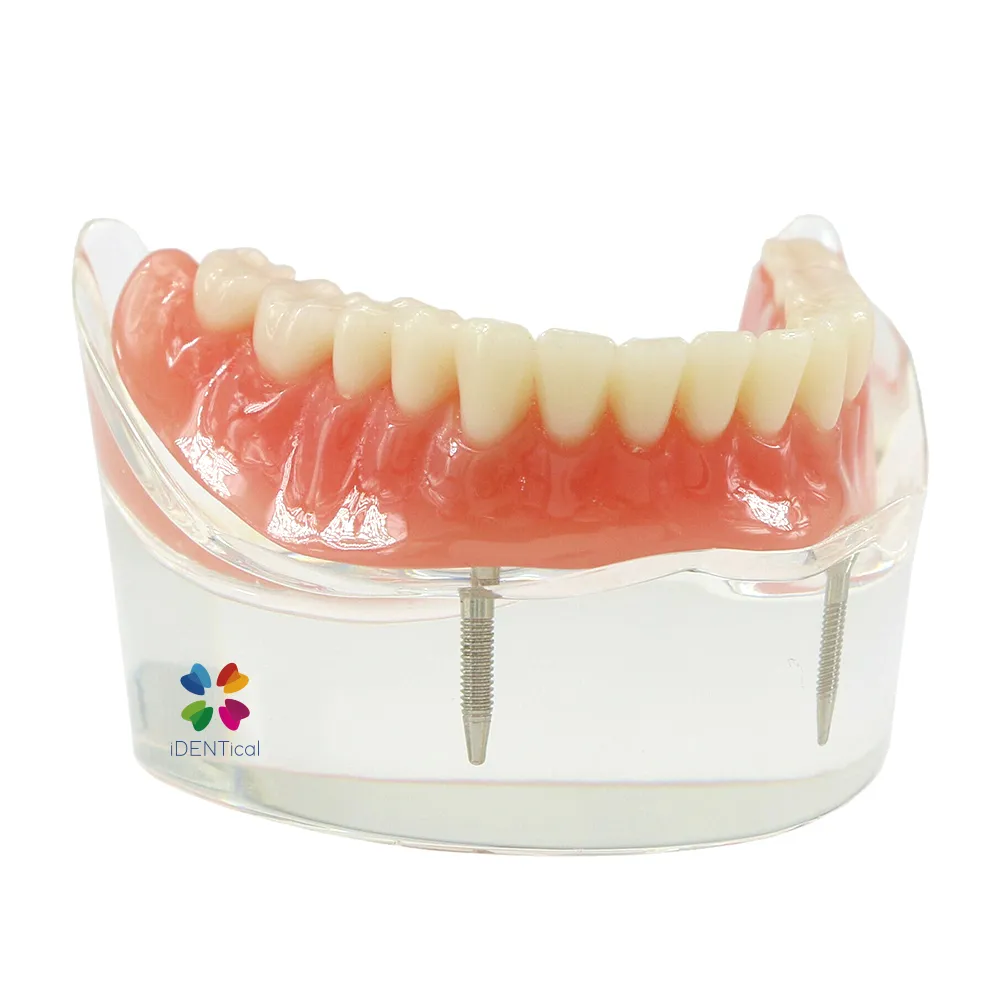 iDENTical Mandibular Overdenture Model with 2 Implants M6002