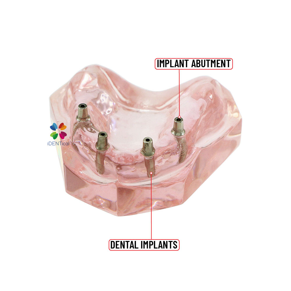 iDENTical Dental Model for Overdenture Maxilla M6001