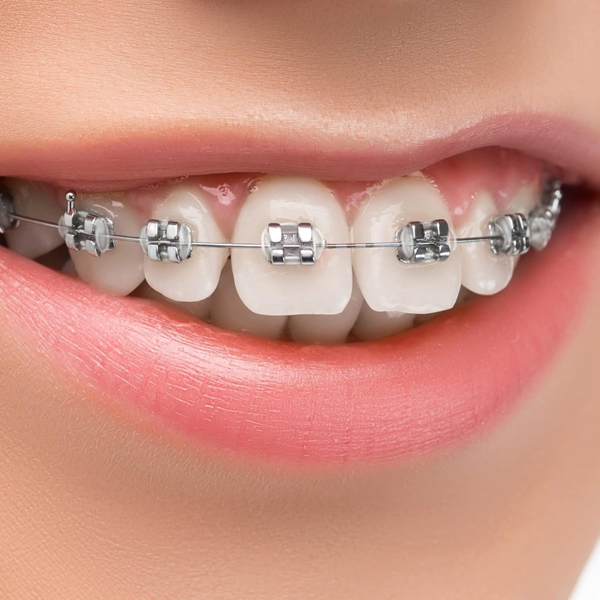 Phyx Power Metal Brackets