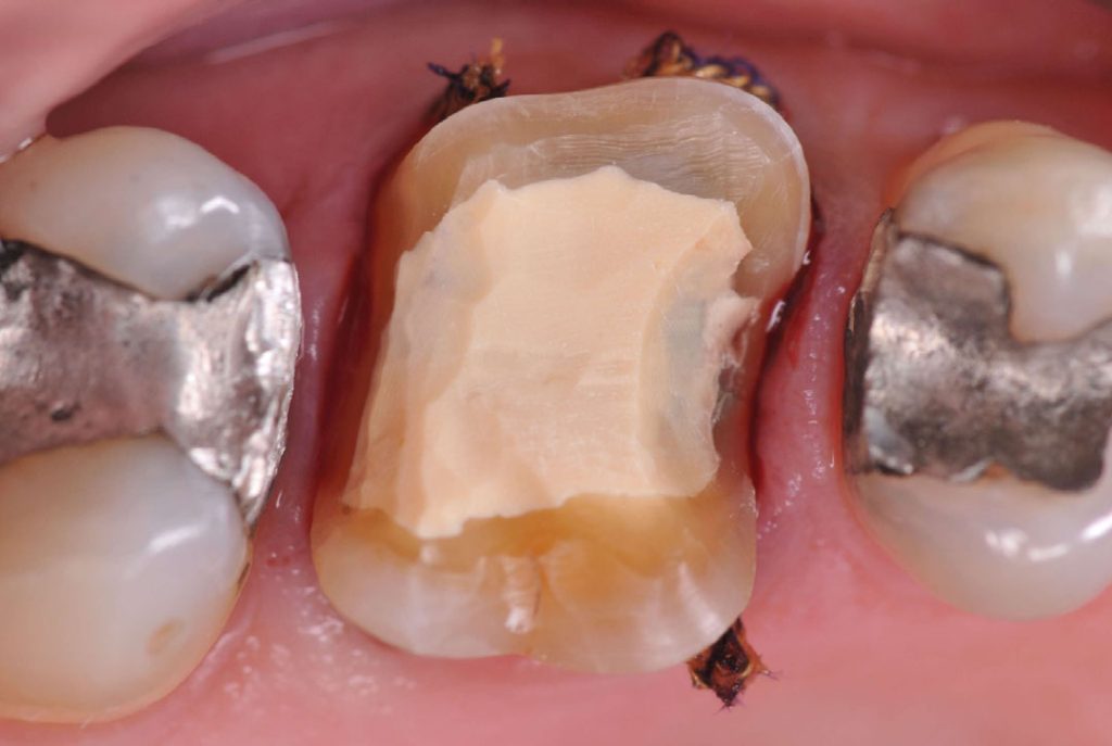 Septodont Biodentine Kit ( Pack of 5 capsules )