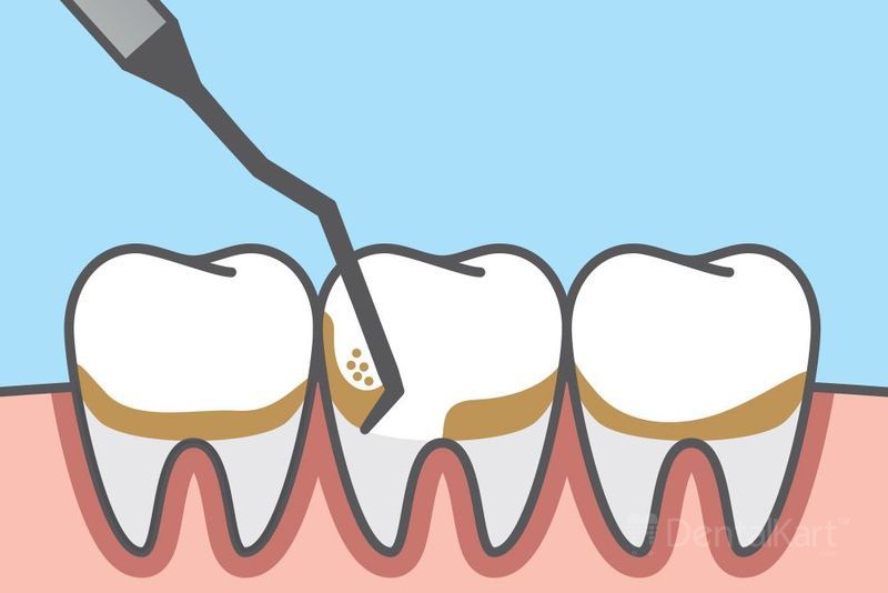 API+ Periodontal Curettes Premium - Langer 3/4