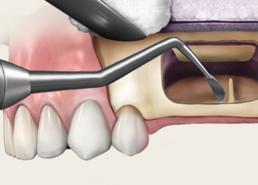 Waldent Sinus Lift Kit 8Pcs Set (K19/6)