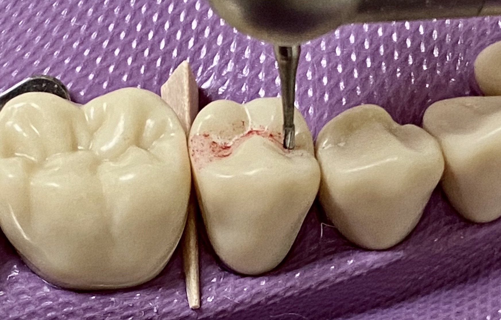 Waldent Push Button Contra-angle Handpiece - Black (W-125)