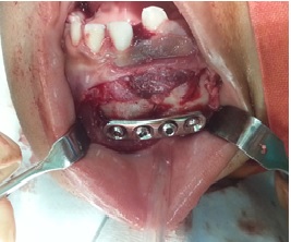 Waldent Langenbeck Retractor 210 x 50 x 10mm (8/107)