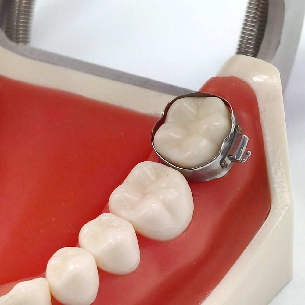 OSL 1st Molar Prewelded Molar Bands MBT 0.022 U2/L1 (Pack Of 4)