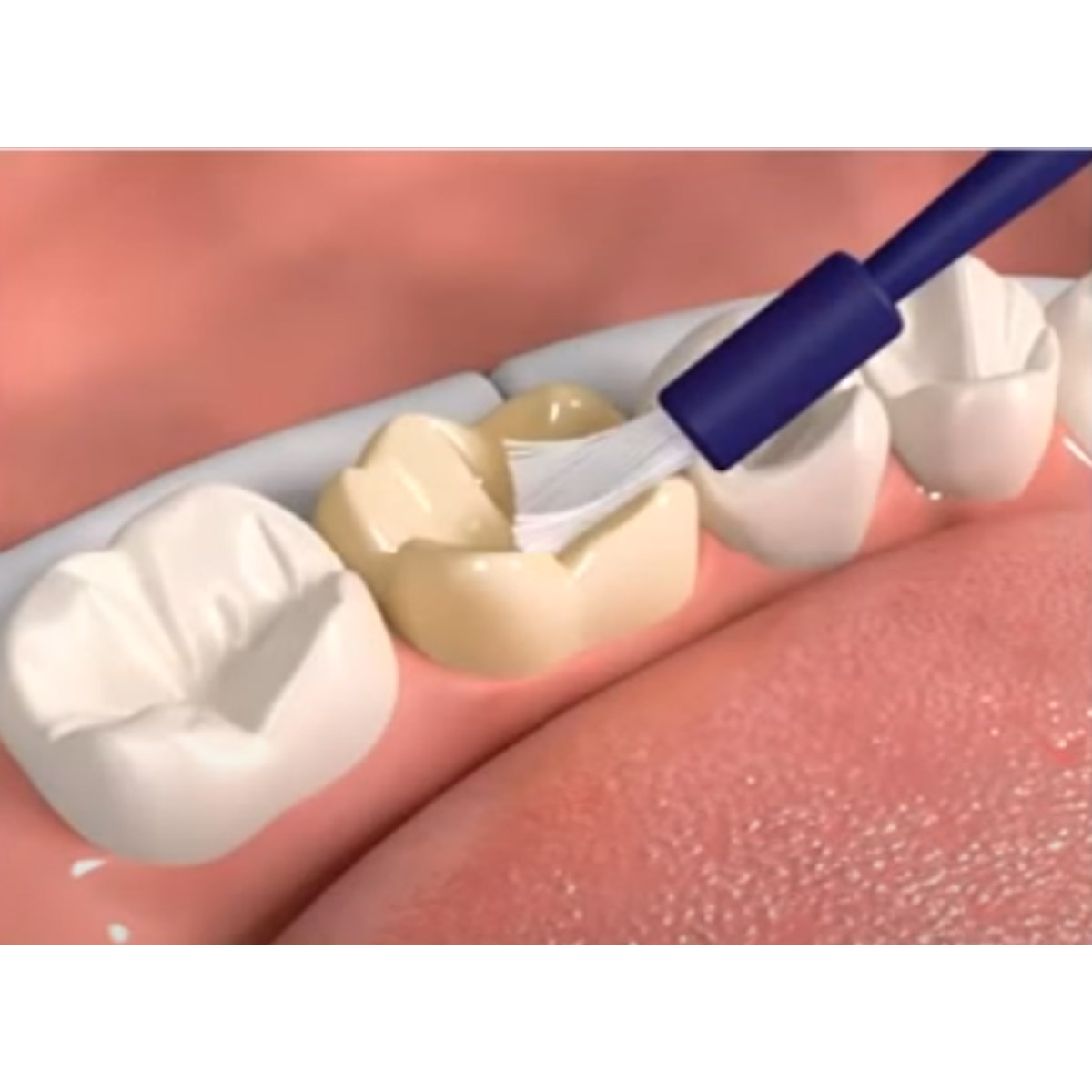 Premier Dental Enamel Pro Varnish