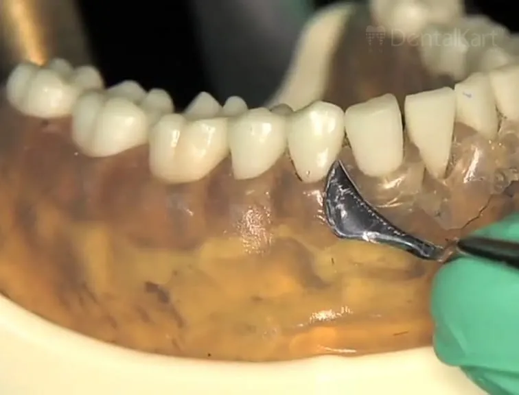 Waldent Periodontal Kirkland Knife 15-16 (15/770)