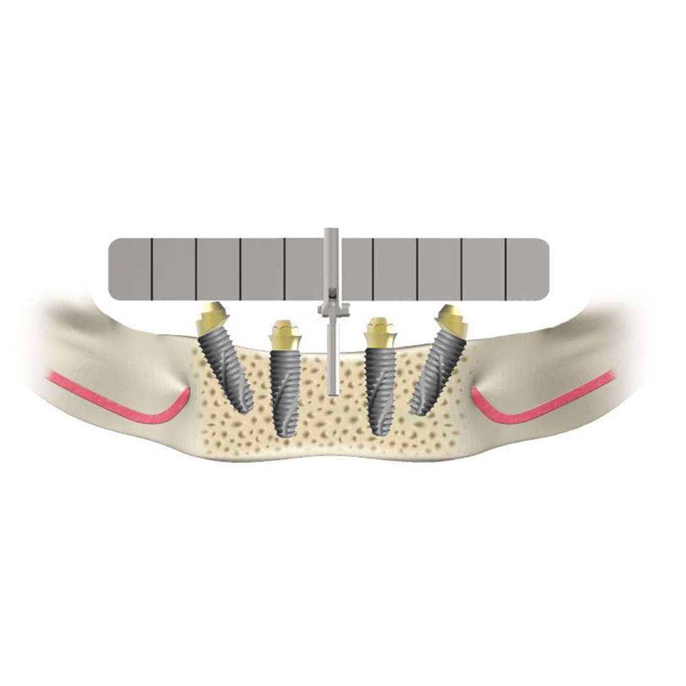 Julldent All on 4 Guide