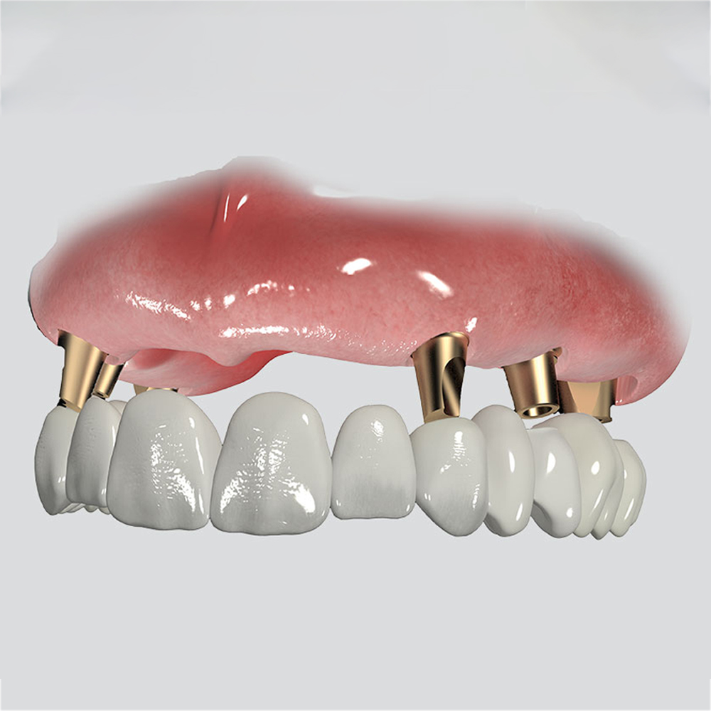Adin CloseFit NP Angled Abutment