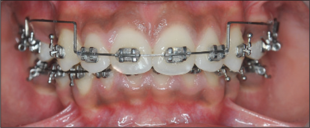 Rabbit Force CIA Niti Intrusion Extrusion Wires Pack of 5 Pcs