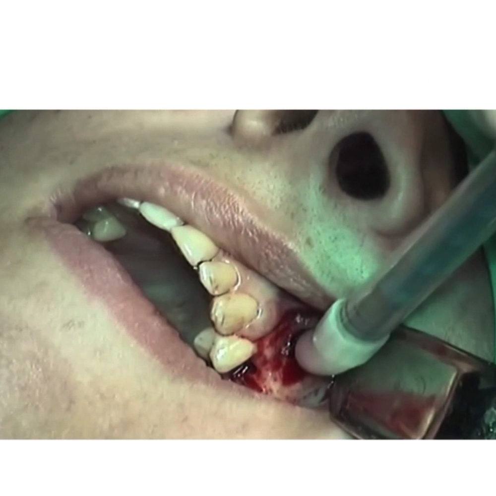 Geistlich Bio-Oss Pen