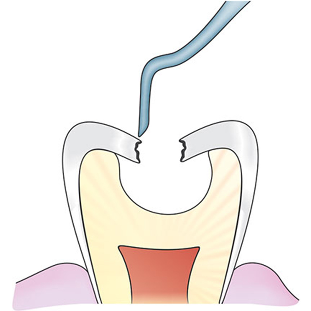 GDC ART Atraumatic Restorative Treatment Instruments