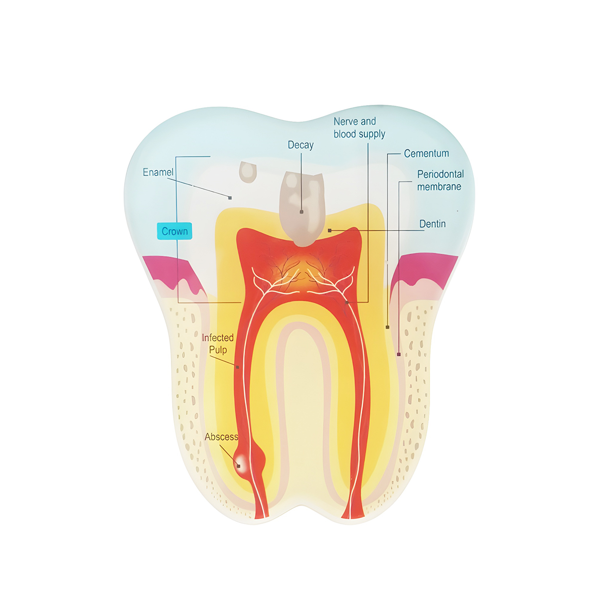 Ivory Tooth Shape Paper Weight - Normal Tooth Vs Carious Tooth